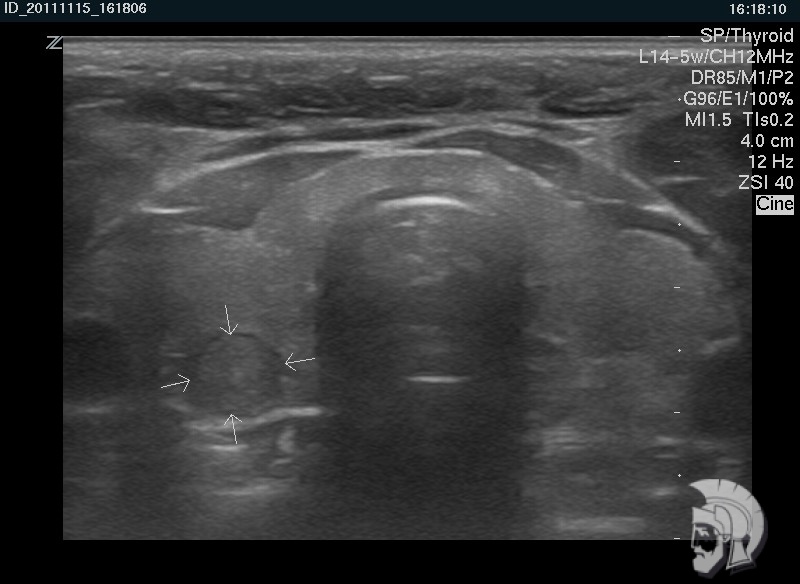 Правосторонний узловой зоб у мужчины 28 лет Правосторонний узловой зоб у мужчины 28 лет